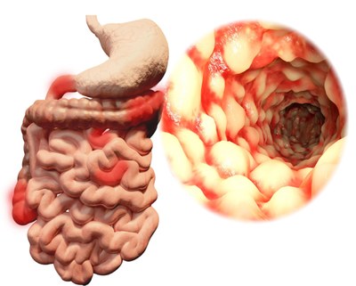 Crohn: onstekingen in maagdarmkanaal