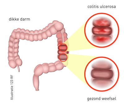 Collitis: ontstekingen in de dikke darm