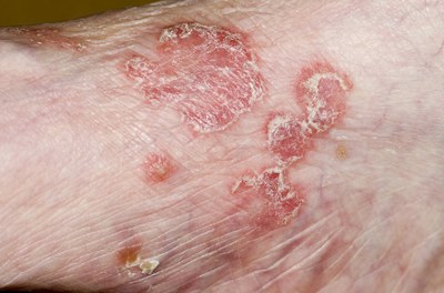 Psoriasis: briakinumab werkt beter