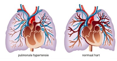 Ambrisentan + tadalafil beter dan monotherapie