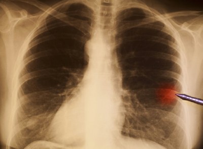 Baat bij nivolumab bij longtumor type NSCLC