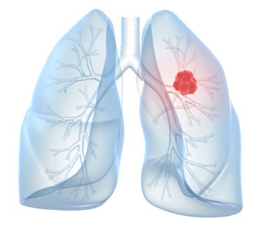 Longkanker: nivolumab  beter dan docetaxel