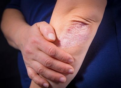 CV-risico psoriasis gelijk aan DM