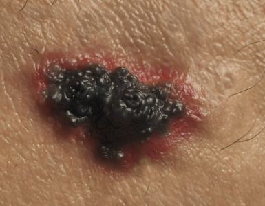 Alternerende therapie zinvol bij ‘verslaafde’ tumorcellen