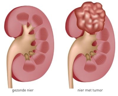 Effect sunitinib als verwacht