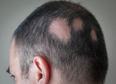 Amper behandelopties bij alopecia