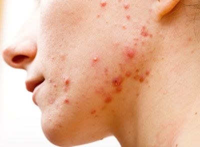 NHG: therapie acne hangt af van de ernst