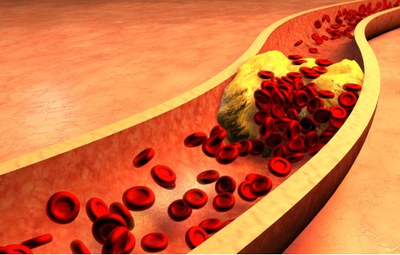 PCSK9-remmer: effect bij veel meer lipiden