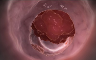 Waarde bevacizumab of cetuximab blijft onzeker