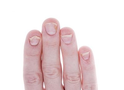 Nagelpsoriasis: adalimumab