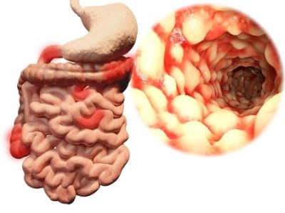 Onderzoek methotrexaat bij ziekte van Crohn