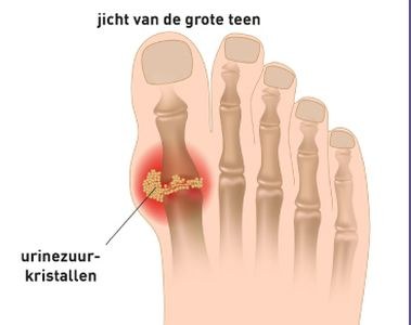 Geen febuxostat bij jicht en hart- en vaatziekten