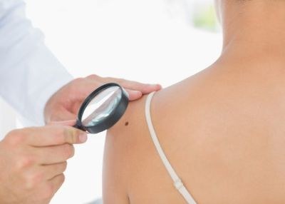 Vitamine D beinvloedt ontwikkeling melanomen