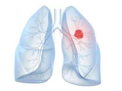 Osimertinib in basispakket