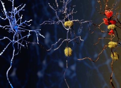 Alzheimermedicijn aducanumab niet toegelaten in Europa