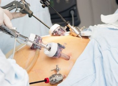Bariatrische chirurgie effectief bij hiv-patiënt met obesitas