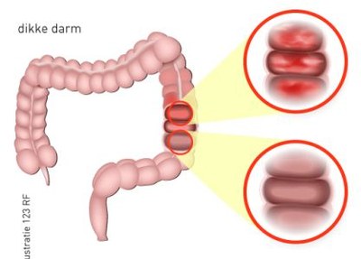 Mirikizumab effectief bij colitis ulcerosa