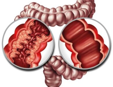 Patiënt met ziekte van Crohn kan toe met minder medicatie