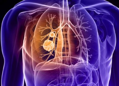 Verhoogd risico op tuberculose bij longkankermedicijn Gavreto