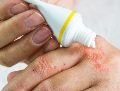 Antibacteriële verbandmiddelen niet aangeraden bij constitutioneel eczeem