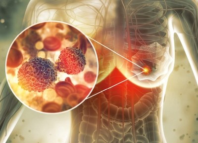 Borstkankermedicijn trastuzumab-deruxtecan voor meer patiënten