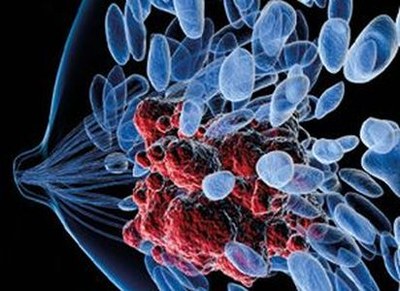 Geen vergoeding chemotherapie en stamceltransplantatie bij borstkanker 