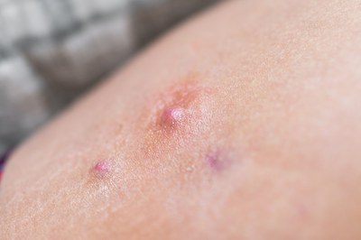 Nieuwe biologicals toe te passen bij chronische huidziekte