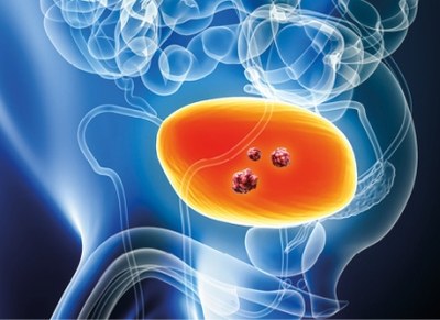 Vergoeding medicijn tegen blaaskanker mogelijk bij lagere prijs