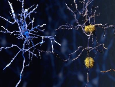 Mogelijke associatie niet-selectieve β-blokkers en alzheimer