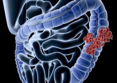 Veelbelovende resultaten met dostarlimab